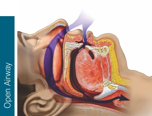 Sleep Apnea Open Airway