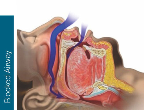 Sleep Apnea Open Airway